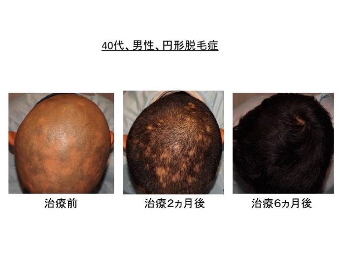 円形脱毛症　病院""